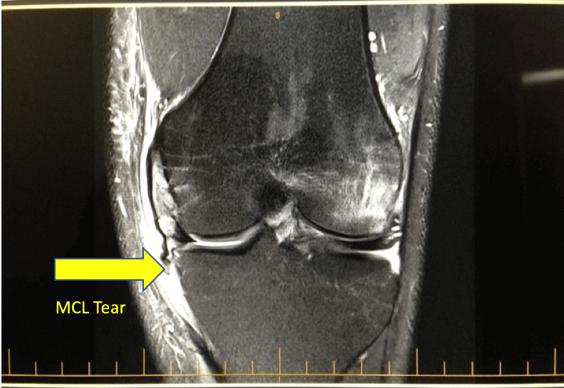 Acl Mcl Injuries Dr Jens Buelow