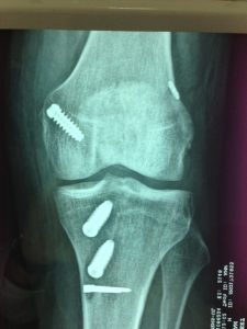 Ligament Injuries Sydney, NSW, ACL, MCL, PCL Tear Randwick