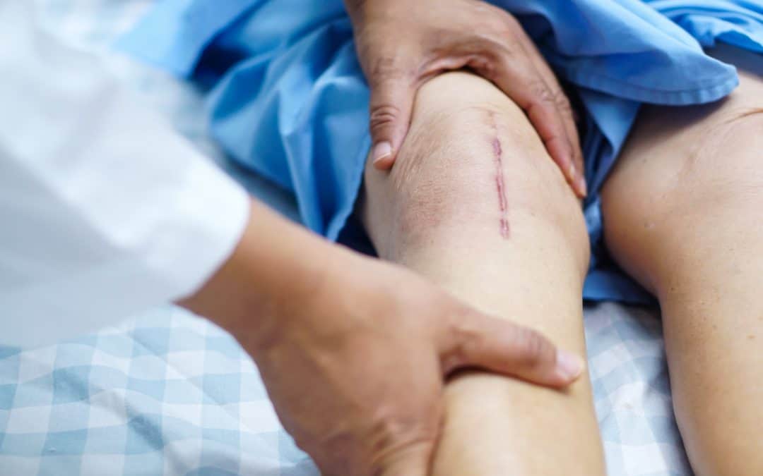 5 Things to Do Before Knee Replacement Surgery